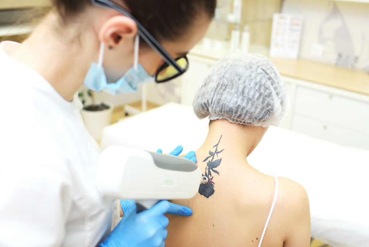 Laser Tattoo Removal